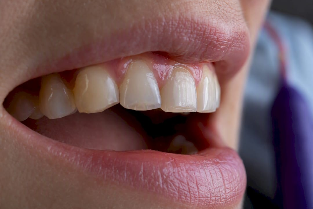Close-up of tooth wear from bruxism