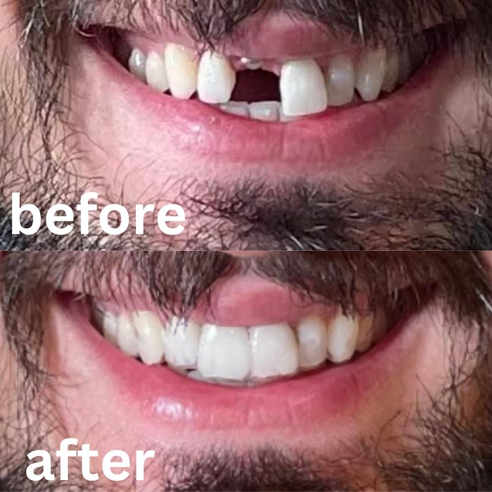 Upper Partial Denture Retainer (1 Tooth Only)
